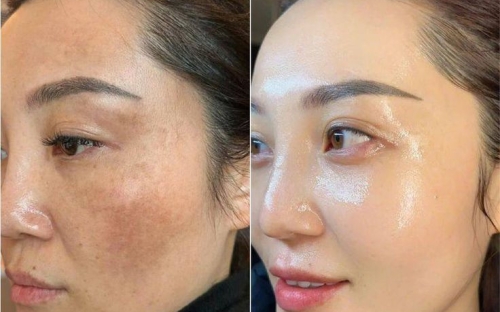 Da yếu, nám, mụn lâu năm có điều trị dứt điểm được không? Spa Nữ Hoàng giải đáp